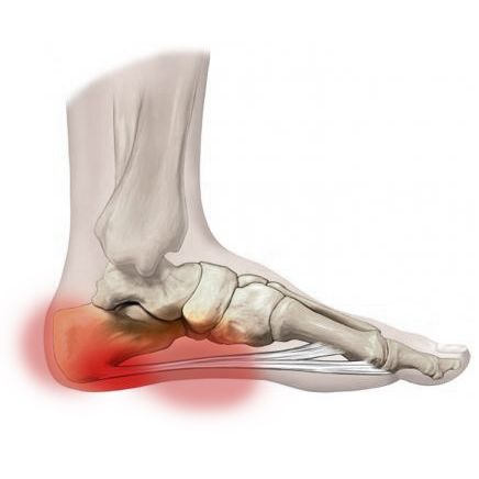 fascitis-plantar