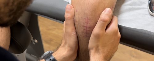 rotura de ligamento cruzado anterior